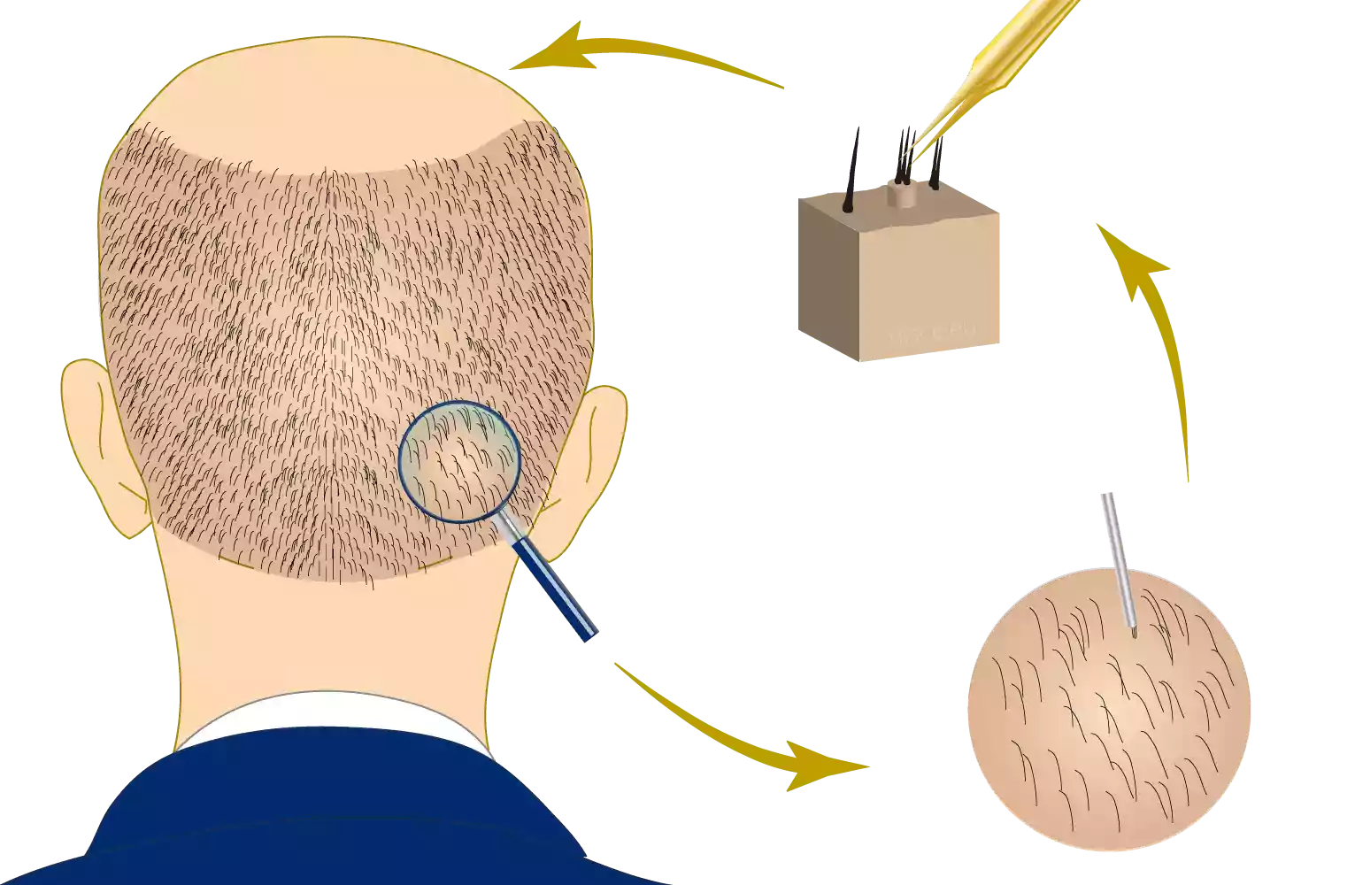 FUE Haartransplantatie methode Illustratie